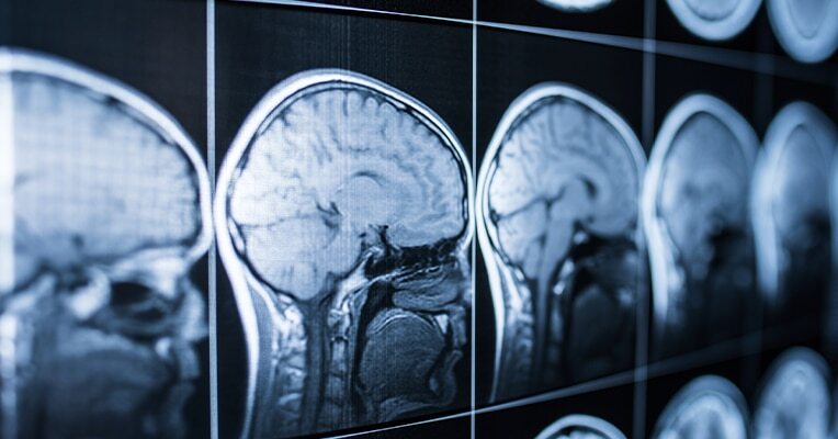 Alton Illinois Traumatic Brain Injury