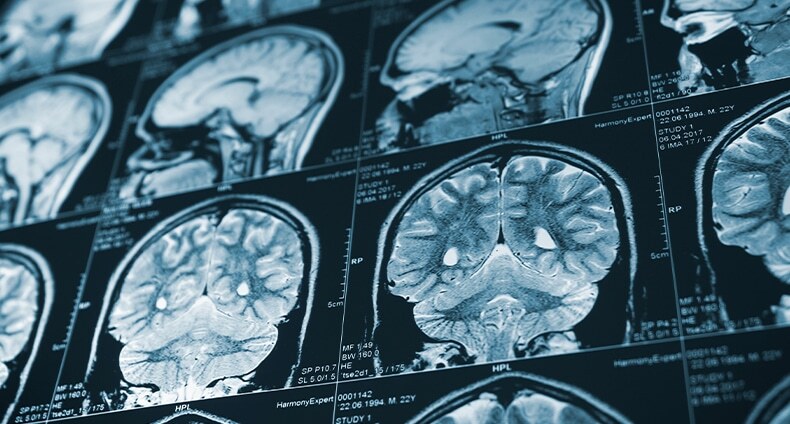 Belleville Traumatic Brain Injury Attorneys